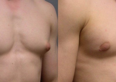 Gynecomastia Correction Progress: Sequential snapshots tracking the improvement in chest aesthetics