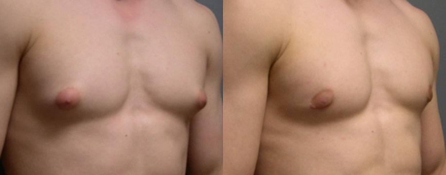 Gynecomastia Correction Progress: Sequential snapshots tracking the improvement in chest aesthetics