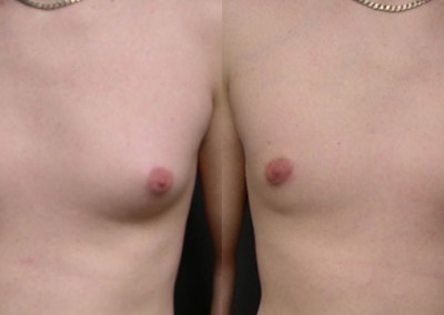 Male Breast Reduction Transformation: Comparative photos revealing the reduction of excess breast tissue