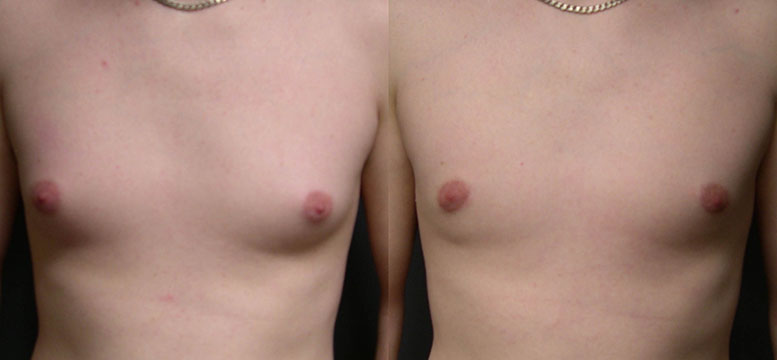 Male Breast Reduction Transformation: Comparative photos revealing the reduction of excess breast tissue