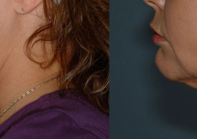 Facial Slimming Transformation: Before-and-after shots revealing the effects of facial liposuction on reducing excess fat