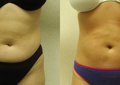 Sculpted Abdomen: Sequential photos illustrating the aesthetic improvements achieved through liposuction on abdomen and waist