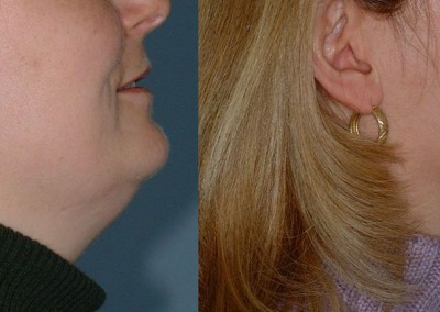 Facial Refinement: Comparative images capturing the impact of facial liposuction on contouring