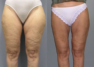 Slimmed Body Profile: Before-and-after snapshots highlighting the noticeable changes from liposuction