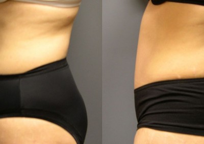 Defined Midriff: Before-and-after shots highlighting the contour refinement achieved with liposuction on abdomen and waist