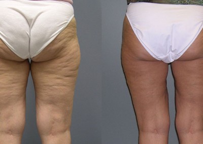 Body Sculpting Results: Visual representation of the aesthetic improvements attained with liposuction