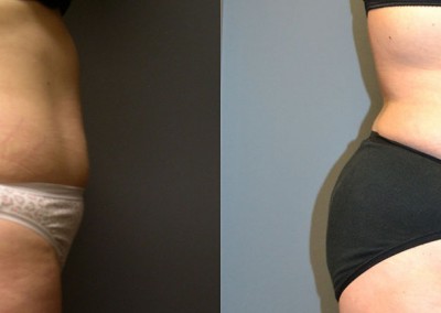 Slimmed Midsection: Before-and-after snapshots capturing the transformative effects of liposuction on abdomen and waist