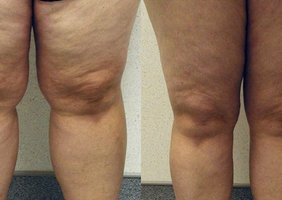 Contoured Figure Evolution: Sequential images illustrating the journey from pre-liposuction to post-treatment