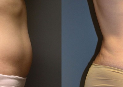 Waistline Redefined: Comparative images portraying the enhanced shape resulting from liposuction on the abdominal and waist areas
