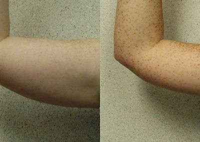 Slimmer arms: Before and after images depicting the results of arm liposuction transformation