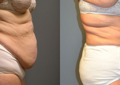 Waist Shaping: Transformational images emphasizing the impact of liposuction on the midsection