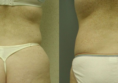 Abdominal Contour Evolution: Visual narrative showcasing the journey from pre-liposuction to post-treatment on abdomen and waist