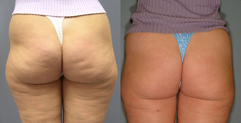 Liposuction and Vela Smooth