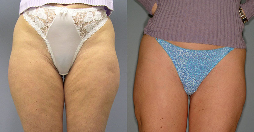 Liposuction and Vela Smooth