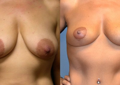 Mastopexy Success Story: Visual evidence of the successful outcome post breast lift surgery