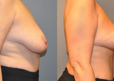 Restored Breast Texture: Before-and-after shots demonstrating the improved firmness