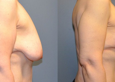 Reshaped Breast Appearance: Visual evidence of the refined contours achieved through mastopexy