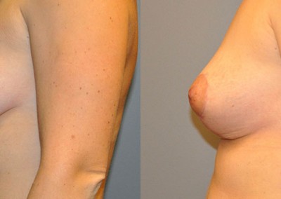 Youthful Breast Contours: Before-and-after snapshots revealing rejuvenated breast aesthetics