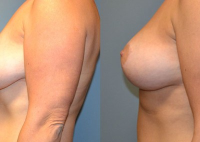 Mastopexy Results Unveiled: Before-and-after images demonstrating the significant improvement