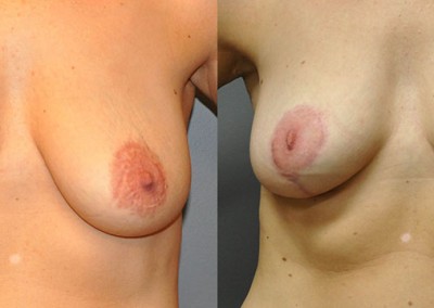 Lifted Breast Projection: Comparison revealing the enhanced forward projection post-surgery