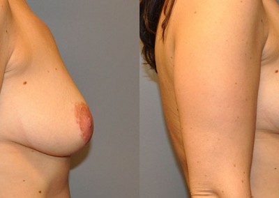 Mastopexy Journey: Images documenting the transformative process of breast lift surgery