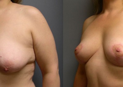 Mastopexy Success Story: Visual evidence of the successful outcome post breast lift surgery