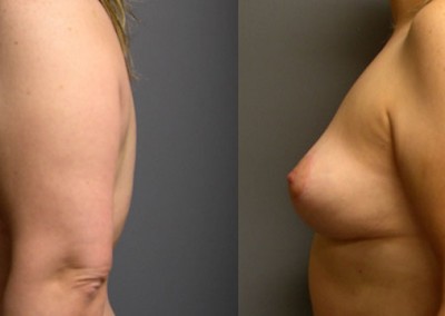 Lifted and Perky Breasts: Before-and-after images highlighting the lifted breast appearance