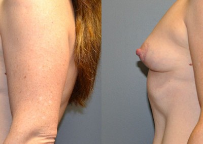 Enhanced Breast Projection: Comparison revealing the improved forward projection