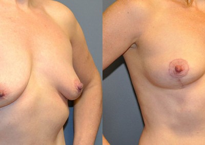 Mastopexy Progress: Side-by-side visuals documenting the transformational journey