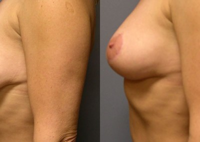 Reshaped Breast Contours: Visual evidence of the refined shape achieved through mastopexy