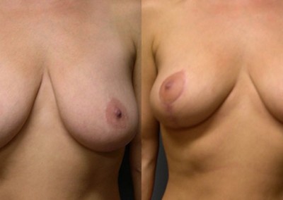 Mastopexy Transformation Journey: Before and after snapshots of the breast lift procedure