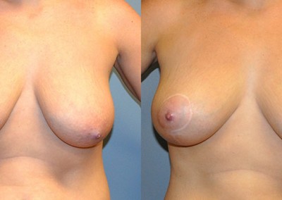 Lifted Breast Profile: Before-and-after images showing the enhanced breast contours