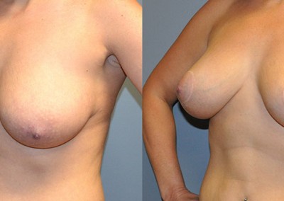 Enhanced Breast Symmetry: Visual comparison highlighting the balanced breast appearance.