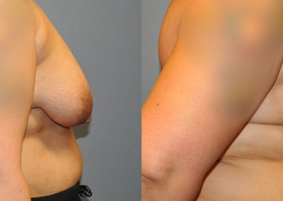 Restored Breast Firmness: Images showing the improved texture and firmness of breasts