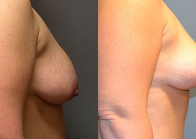 Mastopexy Success Story: Images displaying the successful outcome of breast lift surgery