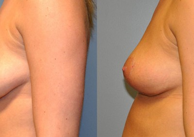 Breast Lift Progress: Side-by-side visuals depicting the gradual improvement post-surgery