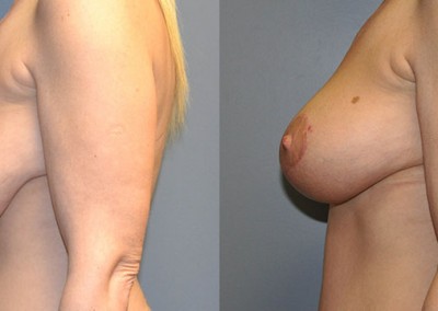 Lifted and Firmer Breasts: Before-and-after photos highlighting the rejuvenated breast contours