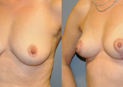 Lifted Breast Contours: Images showing the improved shape and position of breasts
