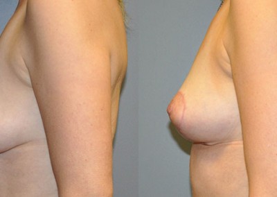 Breast Lift Outcome: Visual comparison of breasts before and after surgery