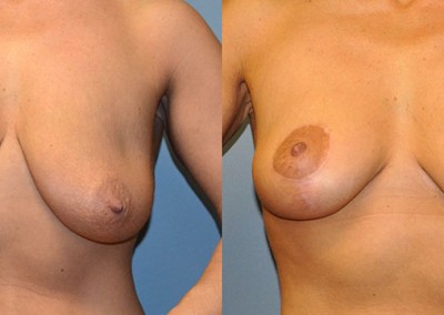 Mastopexy Results: Transformation of breast appearance post-lift