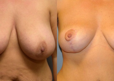 Enhanced Breast Position: Visual comparison of breasts before and after lift procedure