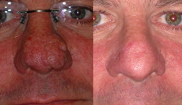 Nasal appearance refinement: Before and after rhinophyma treatment snapshots