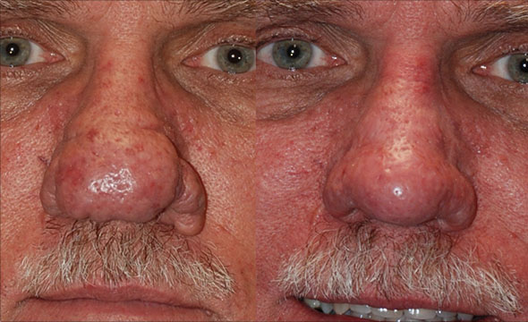 Facial skin enhancement: Rhinophyma correction outcome evaluation