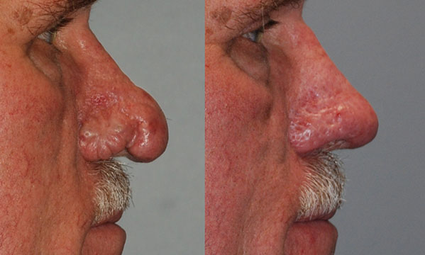 Rhinophyma recovery: Before and after nose condition comparison