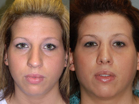 Nose correction: Rhinoplasty before and after comparison