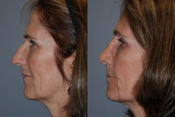 Rhinoplasty outcome: Facial appearance improvement