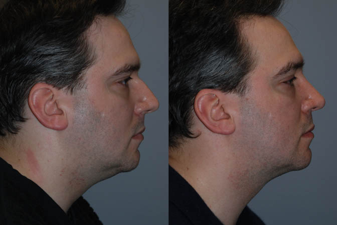 Nasal symmetry enhancement: Before and after rhinoplasty comparison