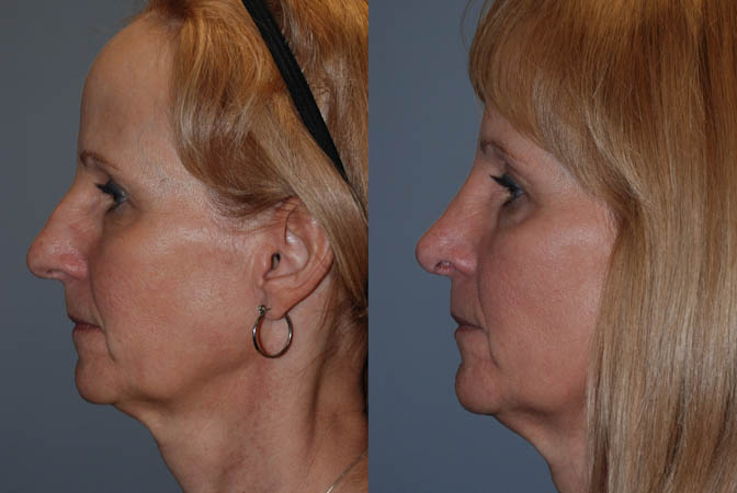 Facial balance restoration: Rhinoplasty transformation images