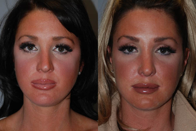 Rhinoplasty results: Nasal reshaping before and after