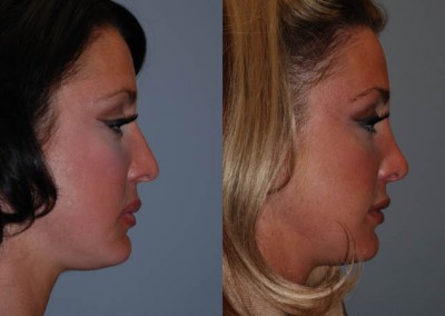 Nose contouring: Before and after rhinoplasty visual comparison